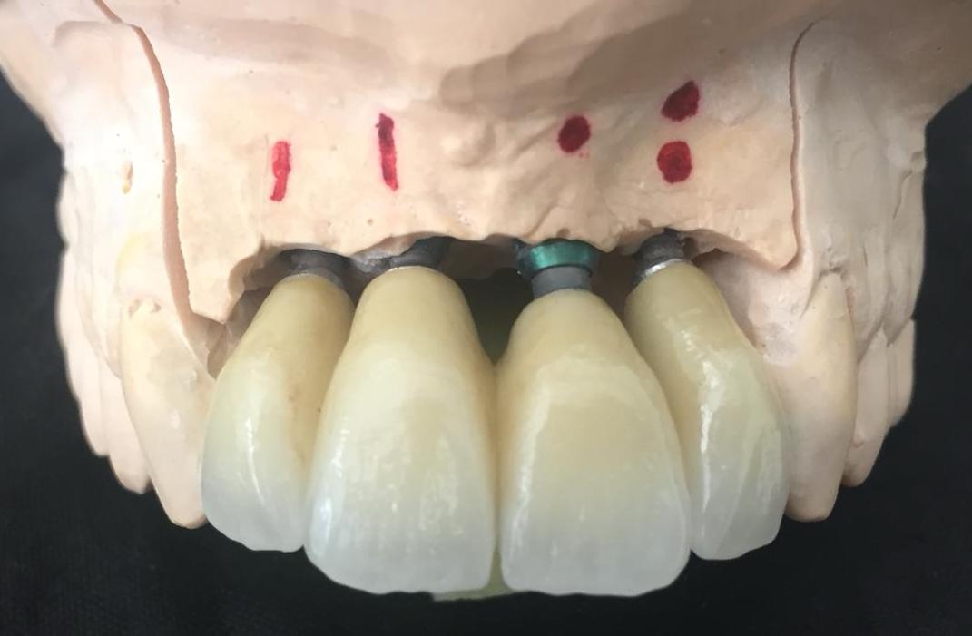Rivenditore Bicon Dental Implant | Biconstore.com ROMA | Promo acquisto impianti 5+1 e 10+3 | Trinia | Manuel Galvez | +39 348 6030028 info@biconstore.it