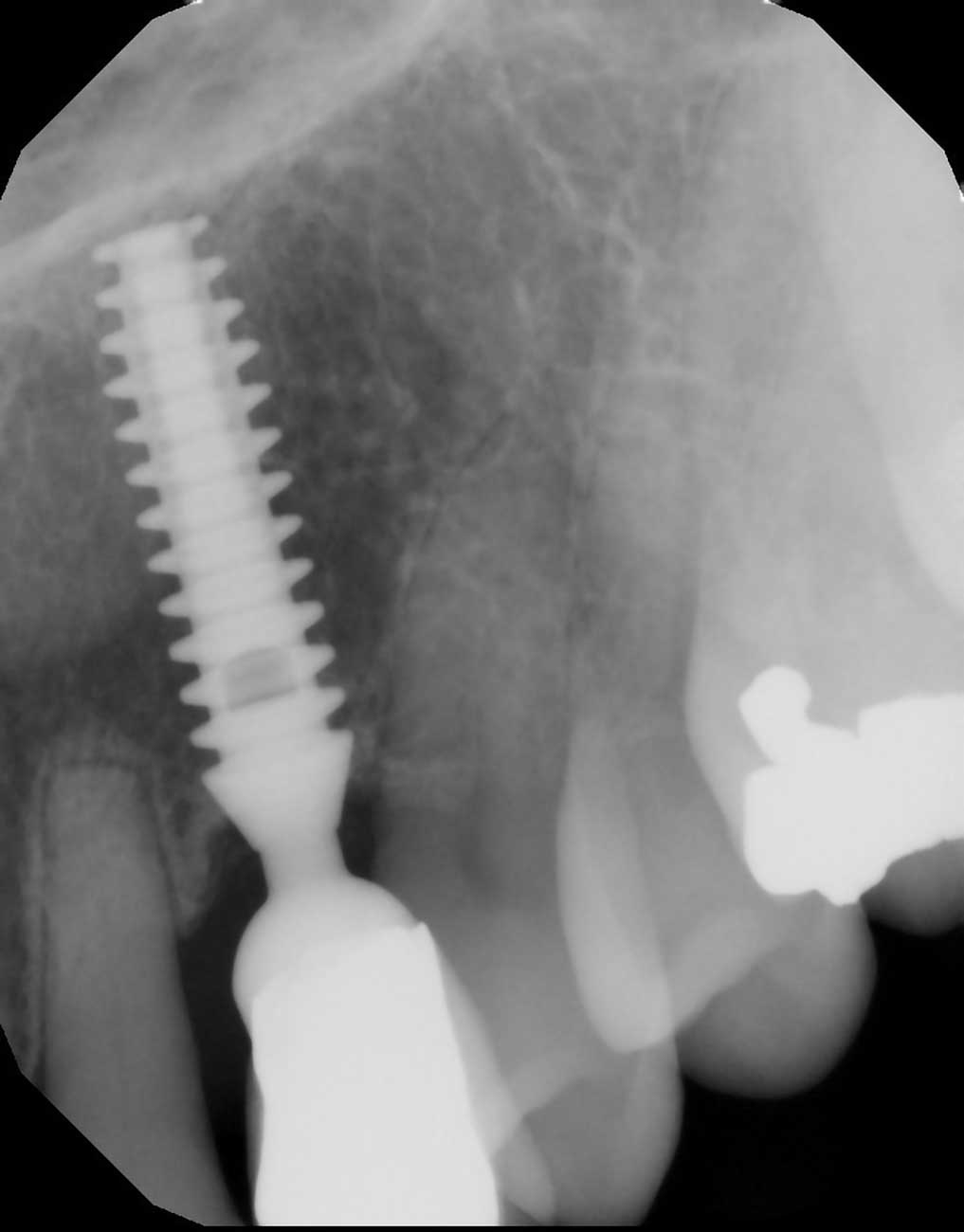 Biconstore.com ROMA | Rivenditore Bicon Dental Implant Centro Sud | Promo acquisto impianti 5+1 e 10+3 | Trinia | Manuel Galvez | +39 348 6030028