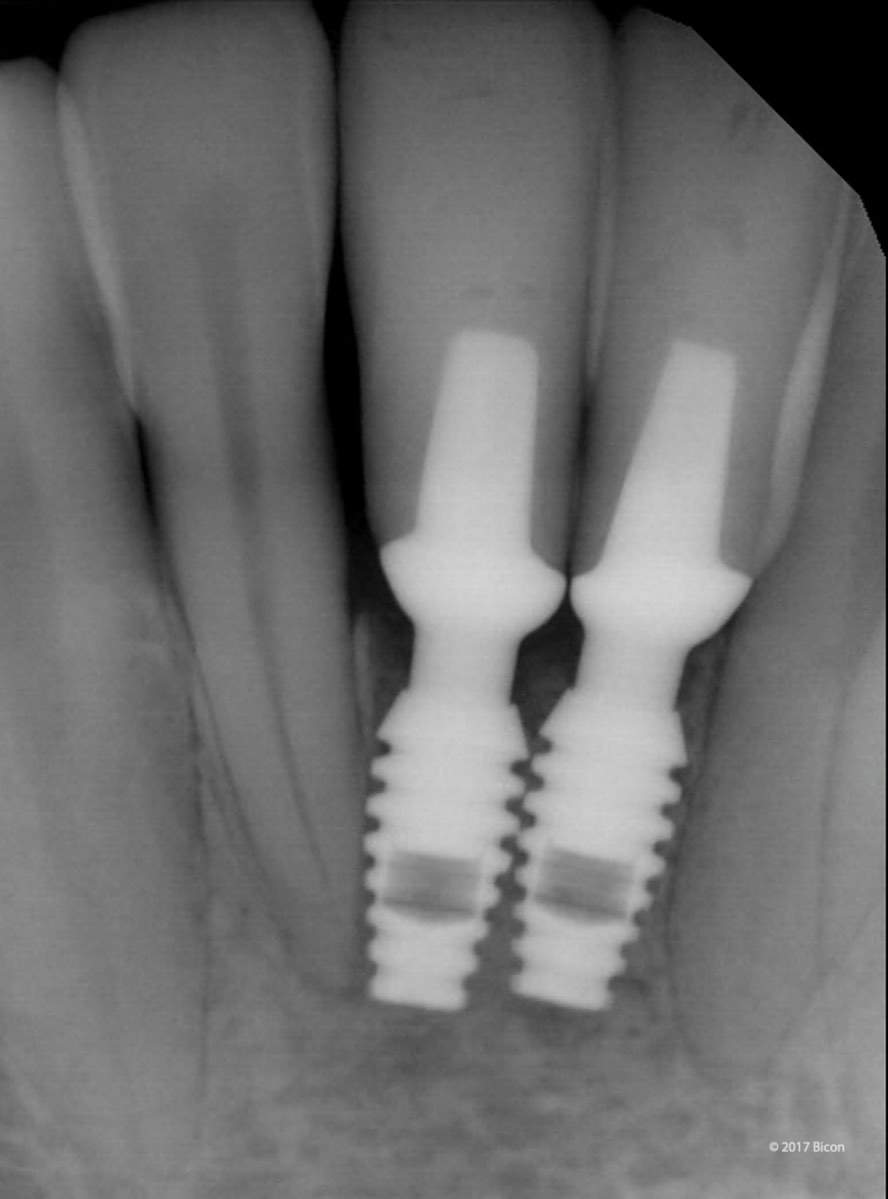 Biconstore.com | Caso | 2 Bicon SHORT® da 3,0 x 6,0 Incisivi Centrali inferiori: "Quando si dice micro…"